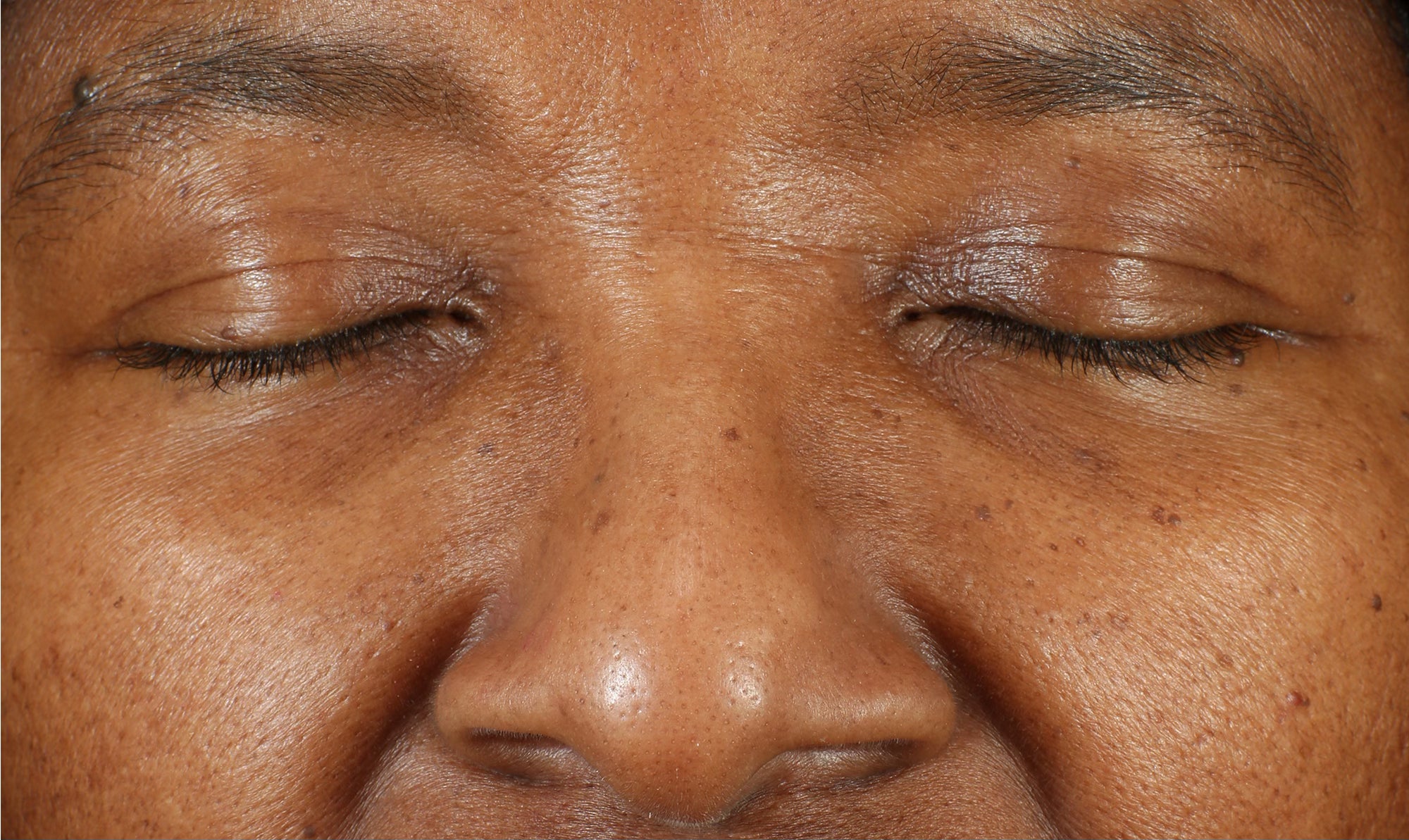 LBH Skincare After- Improved pore size, skin texture, and tone after using LBH AHA Cleanser, Exfoliating Toner, and Prickly Pear Seed Oil.