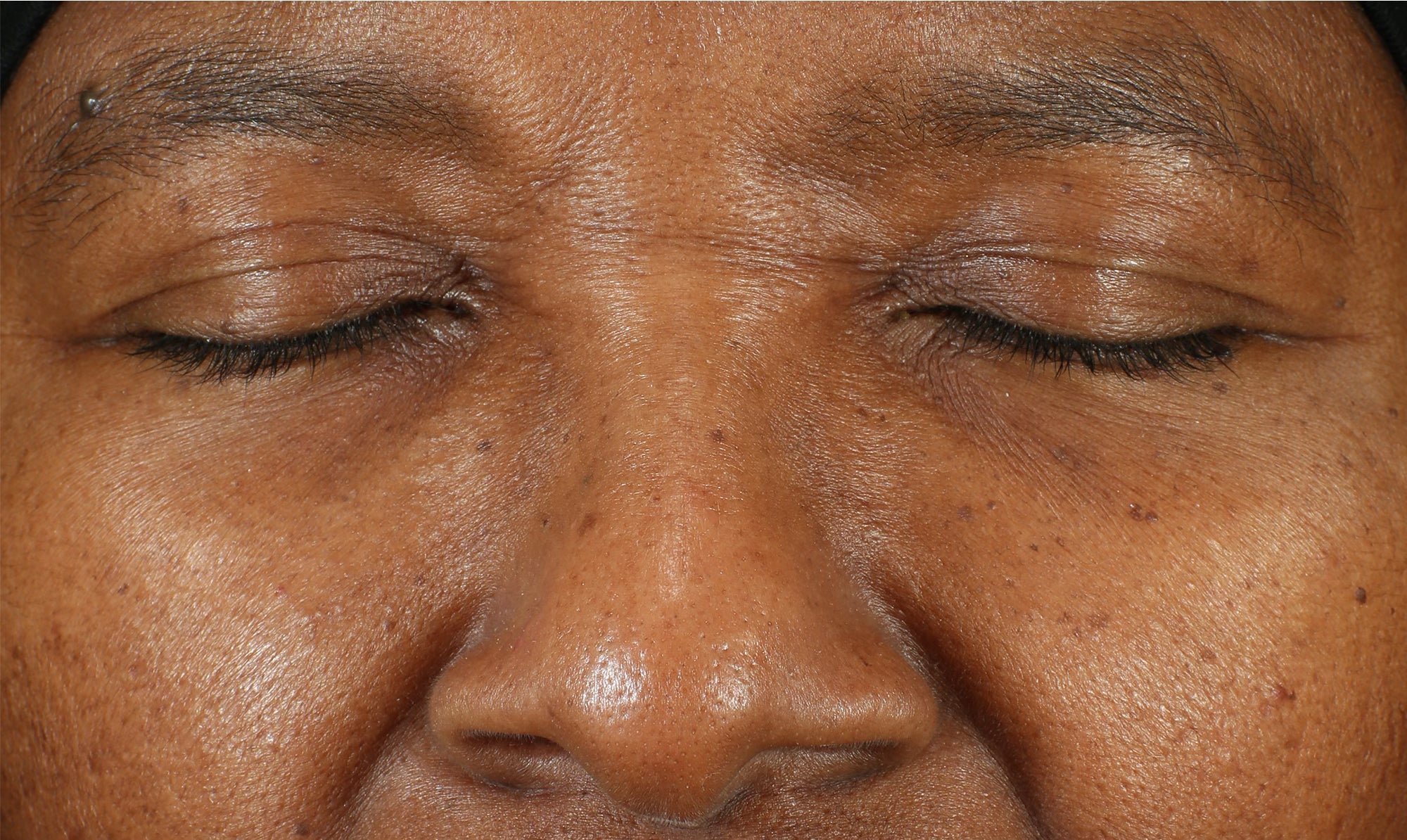 LBH Skincare Before- Patient with enlarged pores, dullness, hyperpigmentation, and fine lines before LBH AHA Cleanser, Exfoliating Toner, and Prickly Pear Seed Oil.