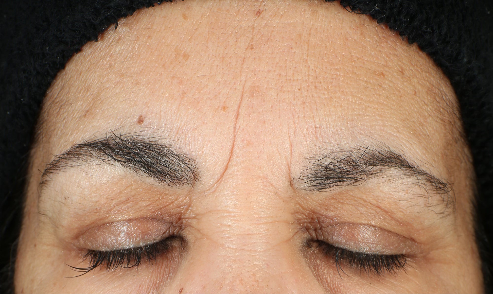 LBH Skincare After- Visible improvement in tone, texture, wrinkles, and pigmentation after LBH AHA Cleanser, Exfoliating Mask, and Prickly Pear Seed Oil.