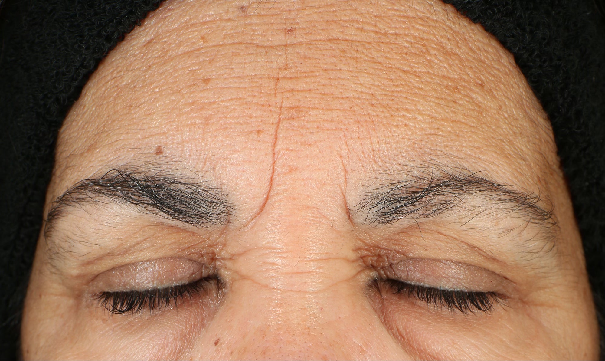LBH Skincare Before Patient exhibiting fine lines, wrinkles, uneven texture, and hyperpigmentation before LBH AHA Cleanser, Exfoliating Mask, and Prickly Pear Seed Oil.