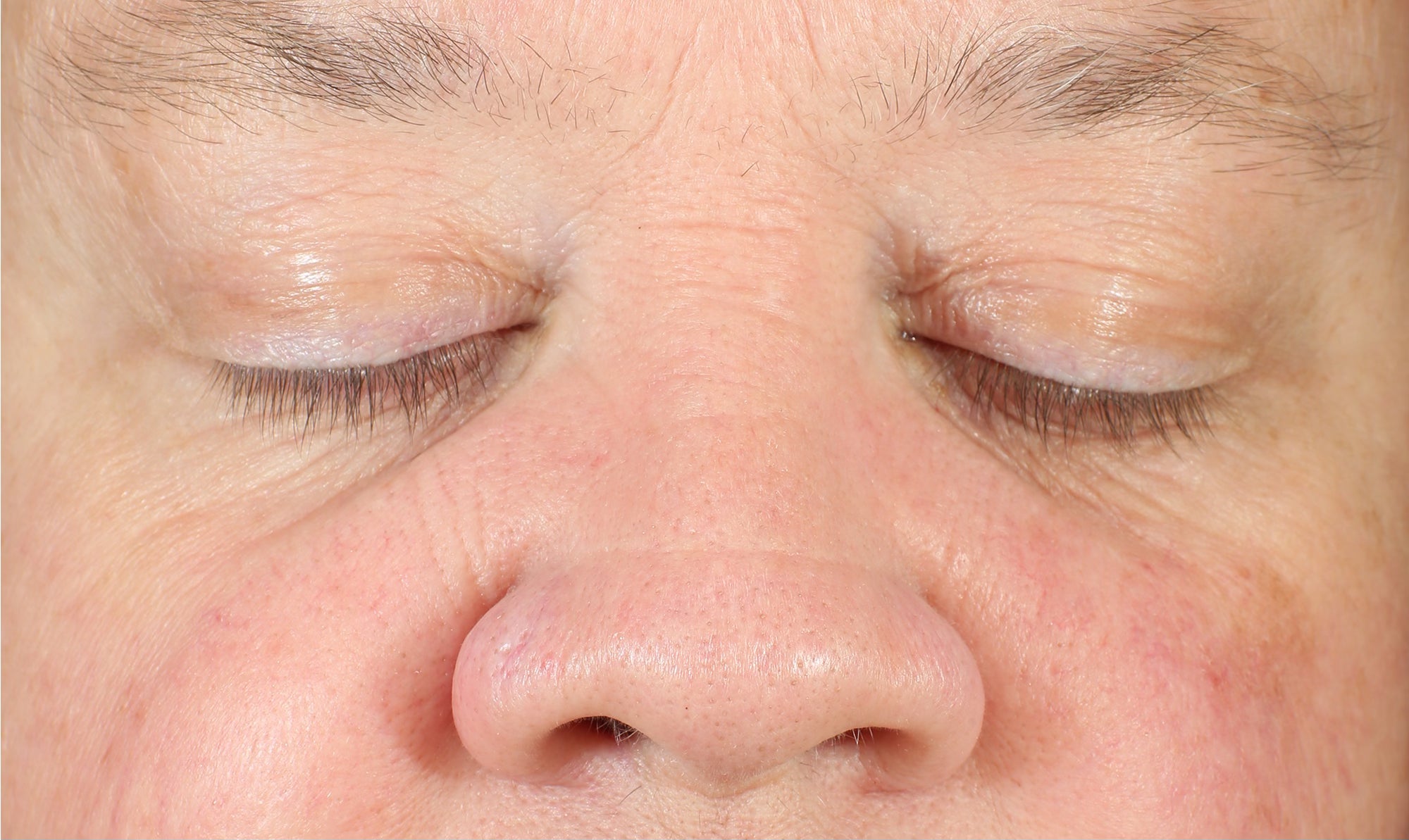 LBH Skincare After- Reduction in redness, hyperpigmentation, and fine lines after consistent use of LBH AHA Cleanser, Exfoliating Mask, Exfoliating Toner, and Prickly Pear Seed Oil.