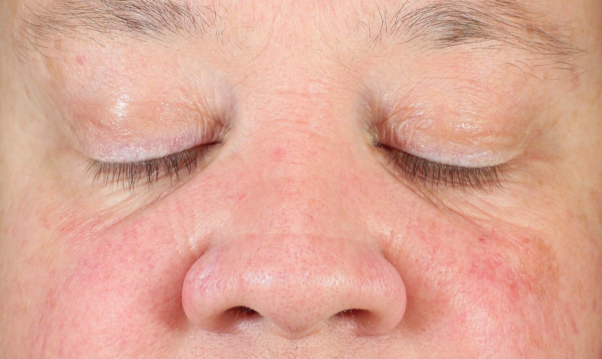 LBH Skincare Before - Patient with visible redness, hyperpigmentation, enlarged pores, and fine lines before using LBH AHA Cleanser, Exfoliating Mask, Exfoliating Toner, and Prickly Pear Seed Oil.