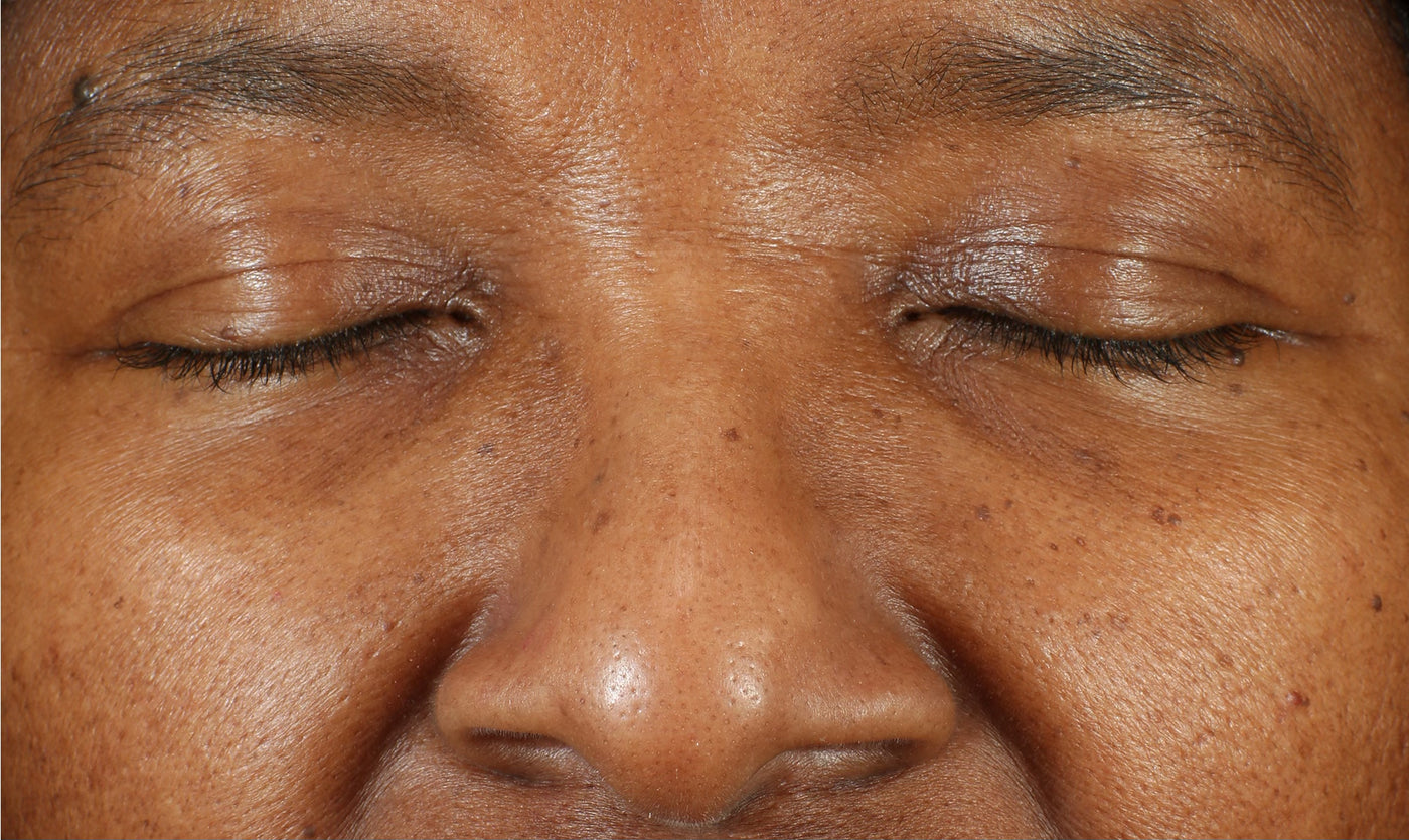 LBH Skincare After-  Improved pore size, skin texture, and tone after using LBH AHA Cleanser, Exfoliating Toner, and Prickly Pear Seed Oil.