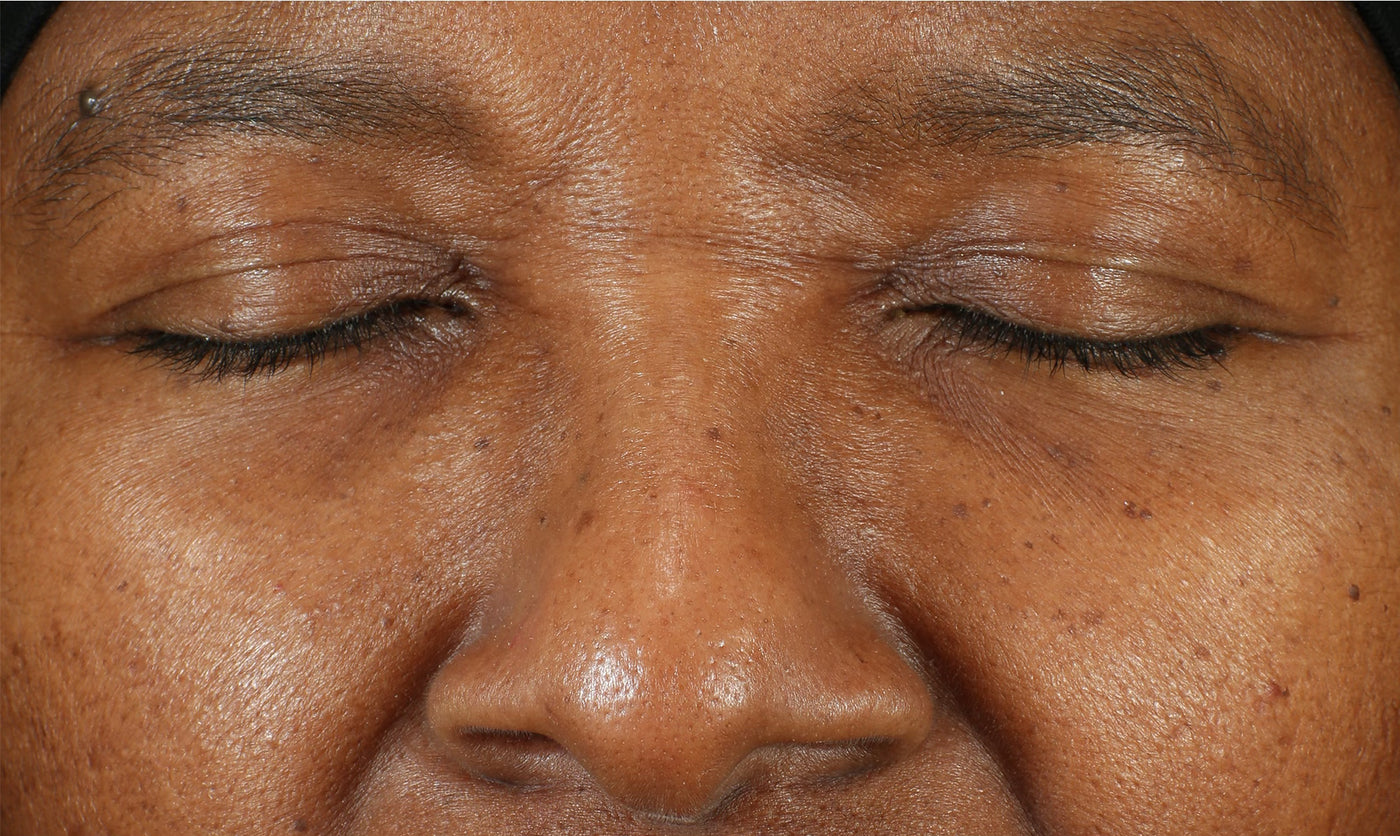 LBH Skincare Before- Patient with enlarged pores, dullness, hyperpigmentation, and fine lines before LBH AHA Cleanser, Exfoliating Toner, and Prickly Pear Seed Oil.