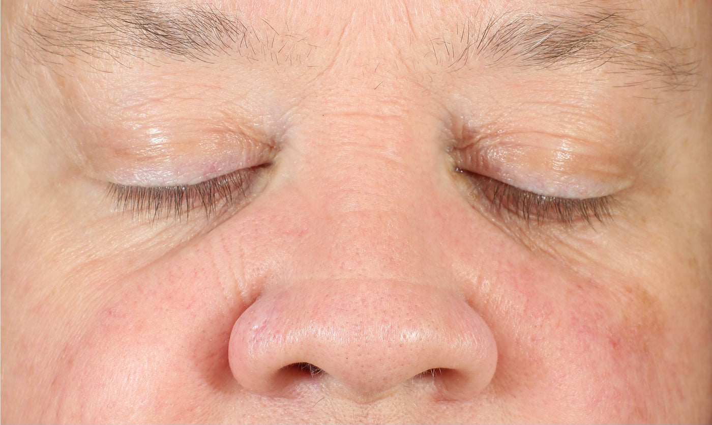 LBH Skincare After- Reduction in redness, hyperpigmentation, and fine lines after consistent use of LBH AHA Cleanser, Exfoliating Mask, Exfoliating Toner, and Prickly Pear Seed Oil.